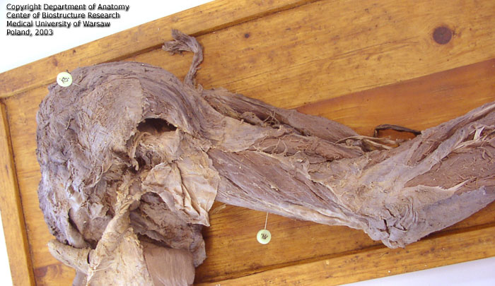 Szpilki -Grzbiet i kończyna górna - baz. M. deltoideus dex., M. triceps brachii dex1.jpg